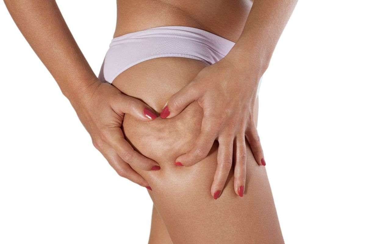 Cellulite addio rimedi